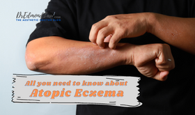 Atopic Eczema Malaysia